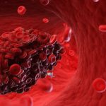 It is important to ensure that we are all aware of the risk factors that play a role in the development of blood clots.