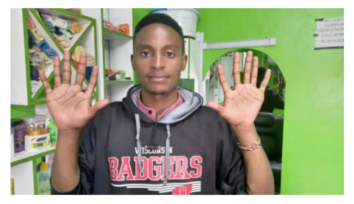 James Kamau - man with six fingers